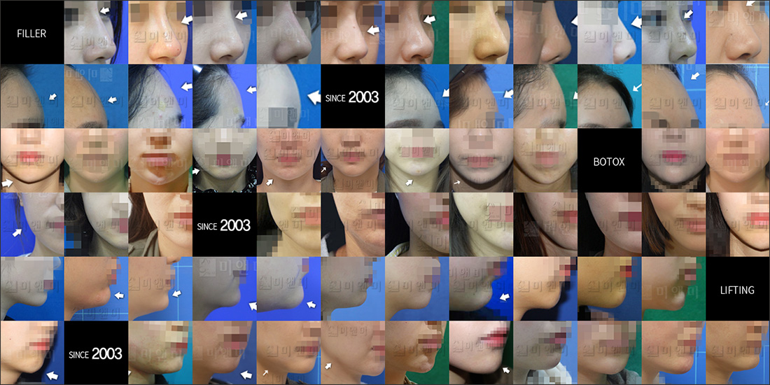 SINCE 2003 MI&MI, 시술후사진모음 안산사각턱보톡스, 안산중앙동사각턱보톡스