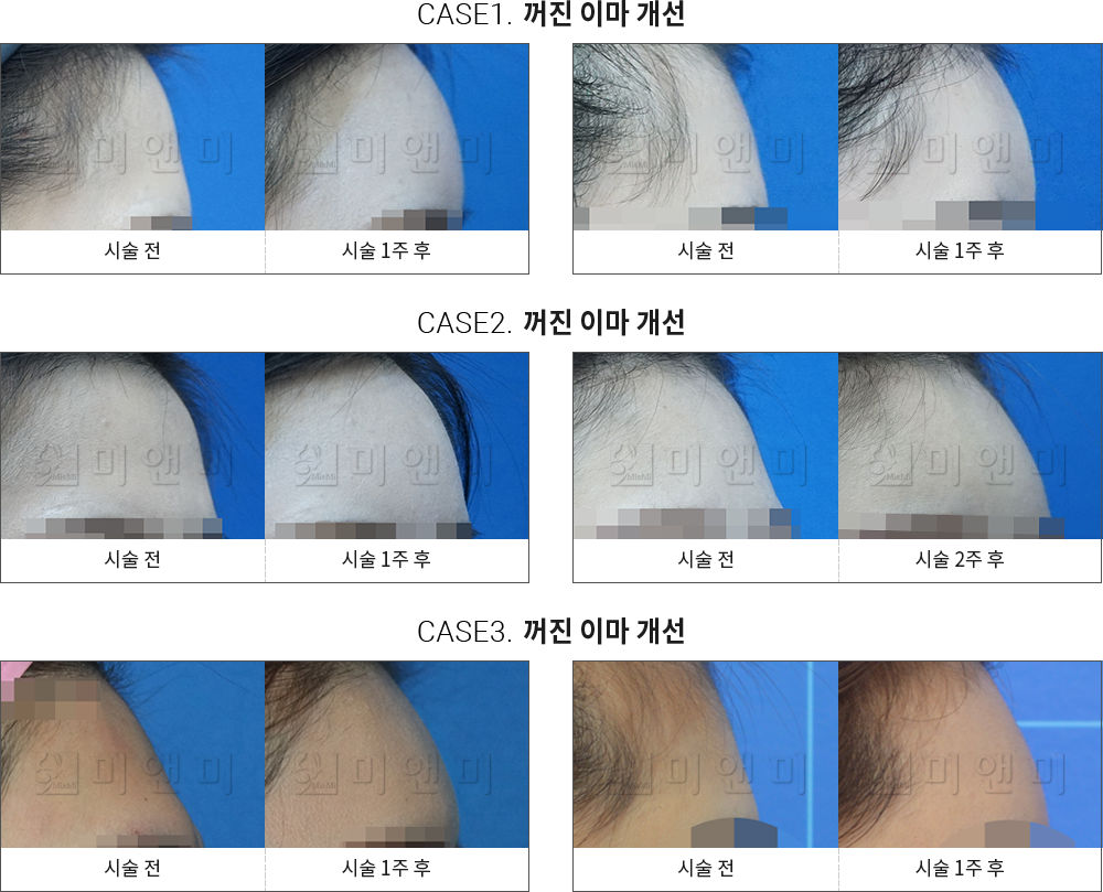 시술전후사진 이마필러 : 무턱개선 안산피부과-중앙동피부과 나에게 꼭 맞는 아름다움 안산피부과 미앤미