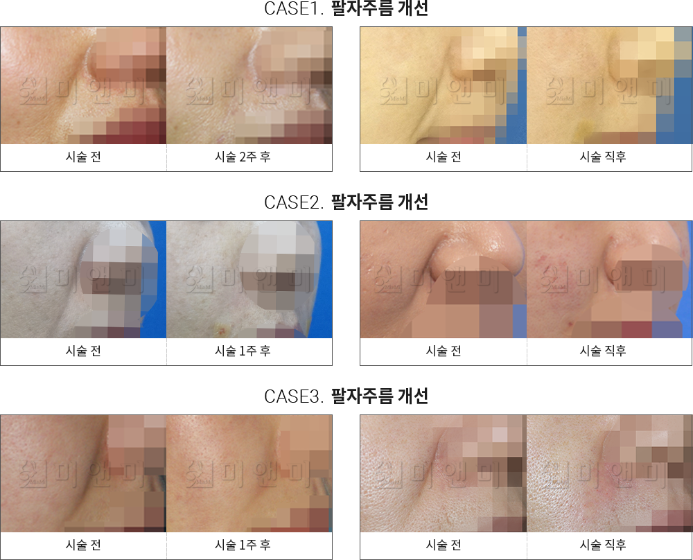시술전후사진 팔자필러 : 팔자주름 개선 안산팔자주름필러, 안산중앙동팔자주름필러