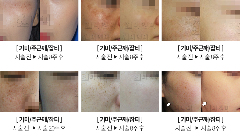 점제거 시술전후